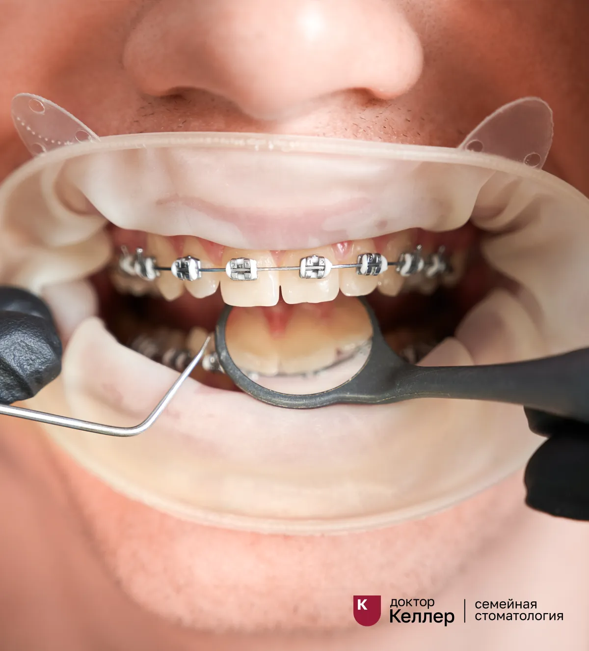 Установка металлических брекетов в Батайске: цены в клинике Доктор Келлер