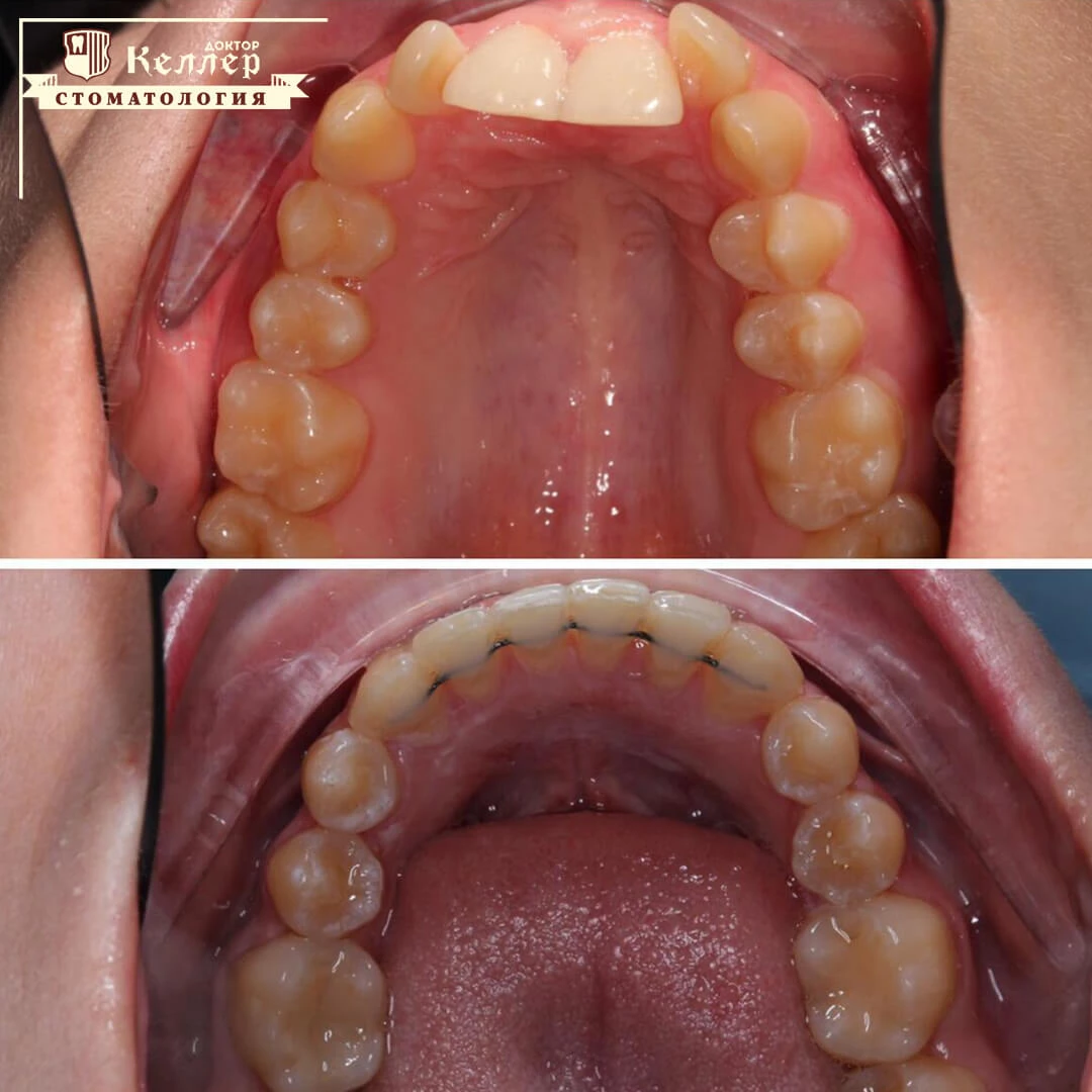 Брекеты в Батайске: установка и снятие брекет-систем в Батайске - Доктор  Келлер